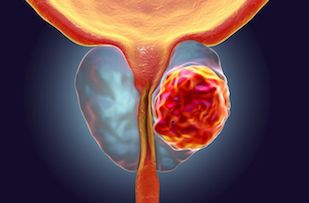 cancer de la prostate symptômes précoces urină cu sânge la bărbații cu prostatită